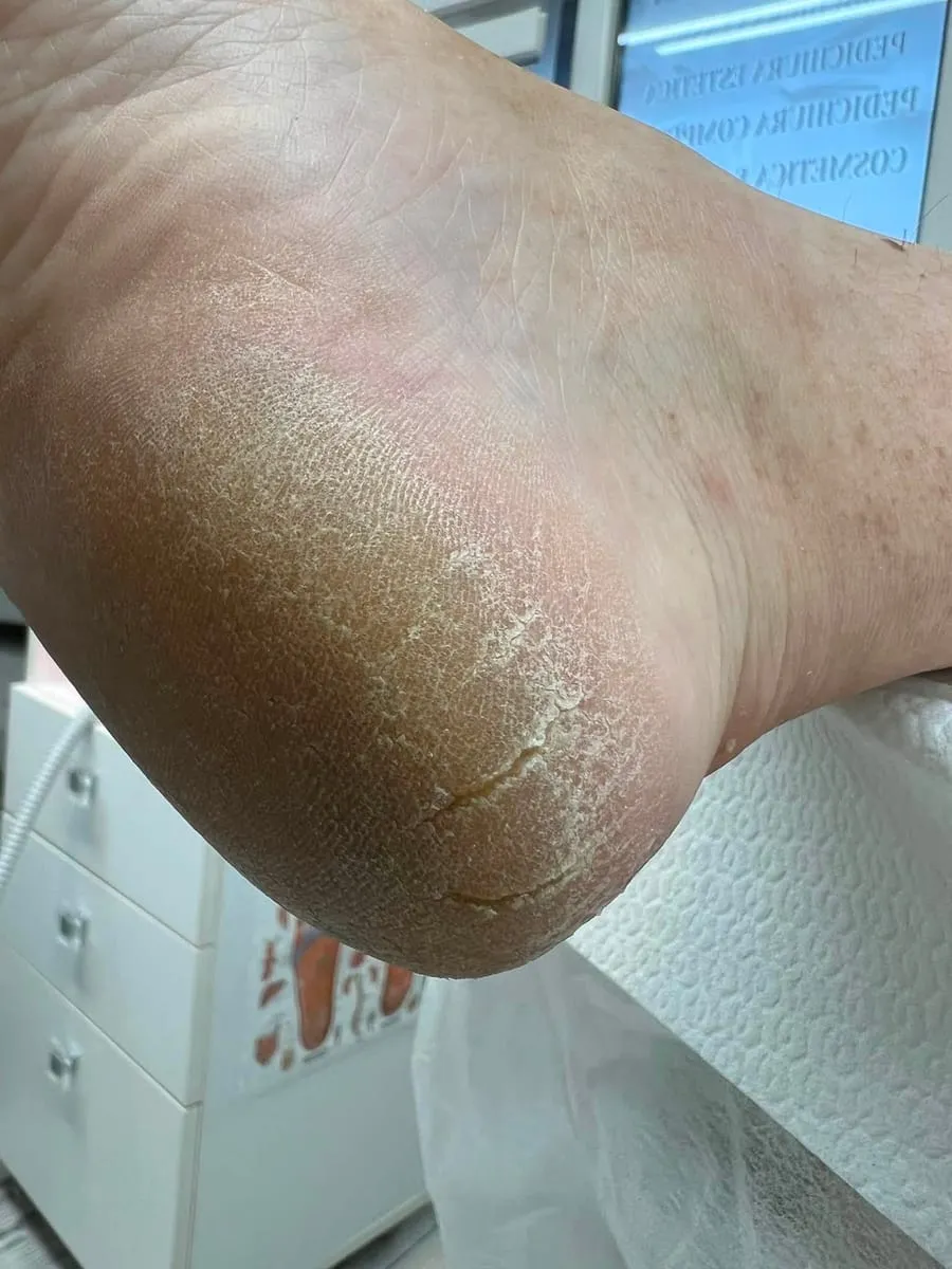 Călcâi cu piele uscată și îngroșată, înainte de îngrijire