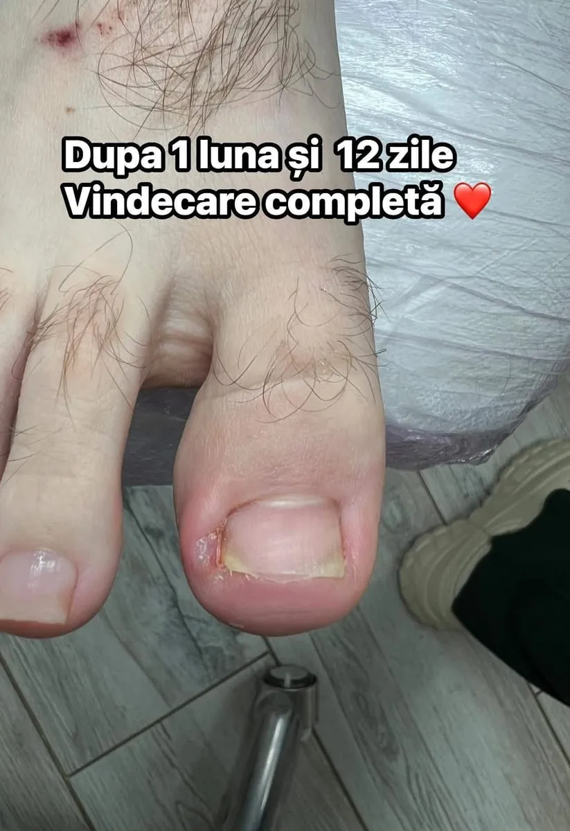 Aceeași unghie după perioada de îngrijire